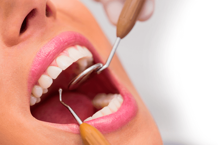 Facetas dentárias.